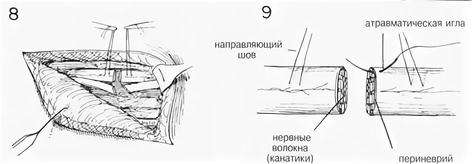 Сшивание нерва латынь. Эпиневральный шов нерва. Периневральный шов нерва техника. Сшивание нерва операция. Шов нерва топографическая анатомия.