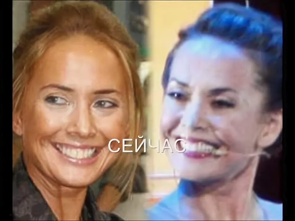 Наталья Фриске до и после пластики 300 ЭКСПЕРТОВ Дзен