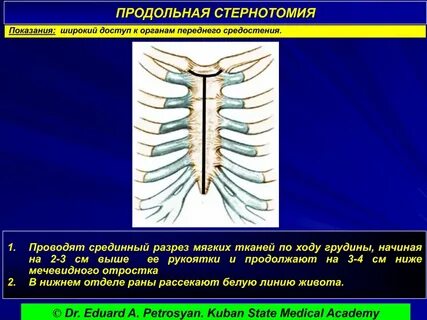 Расширение грудины