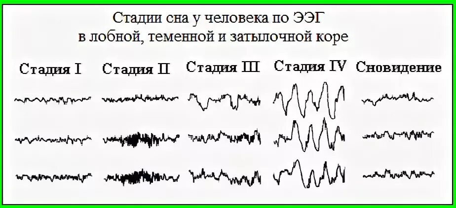 Ээг 2 часа. Нарисовать схему стадий сна по данным ЭЭГ.. 1. Нарисовать схему стадий сна по данным ЭЭГ.. Фазы сна показатели ЭЭГ. ЭЭГ В разные фазы сна.