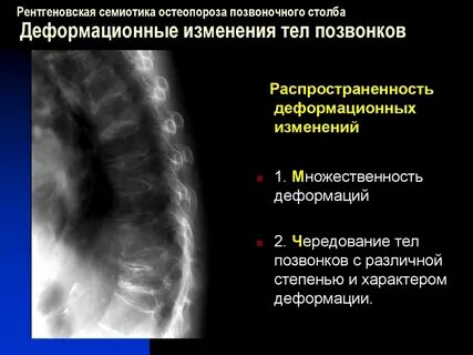 Деформации позвоночного столба