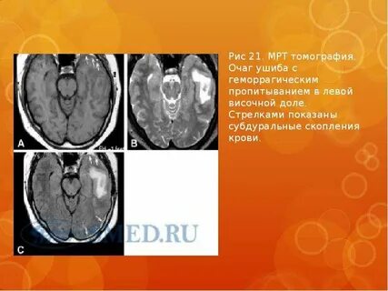 Очаг правой