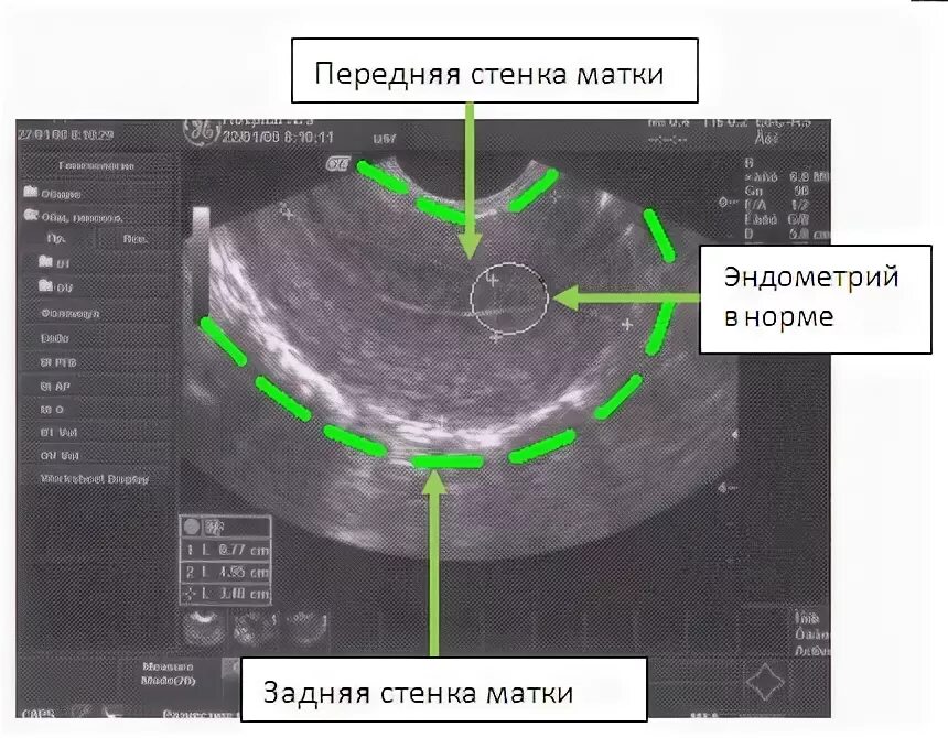 Толщина эндометрия на УЗИ норма. Эндометрий толщина по УЗИ норма. Толщина стенок матки в норме на УЗИ. Трехслойная структура эндометрия (УЗИ). Какая эндометрия должна быть в норме