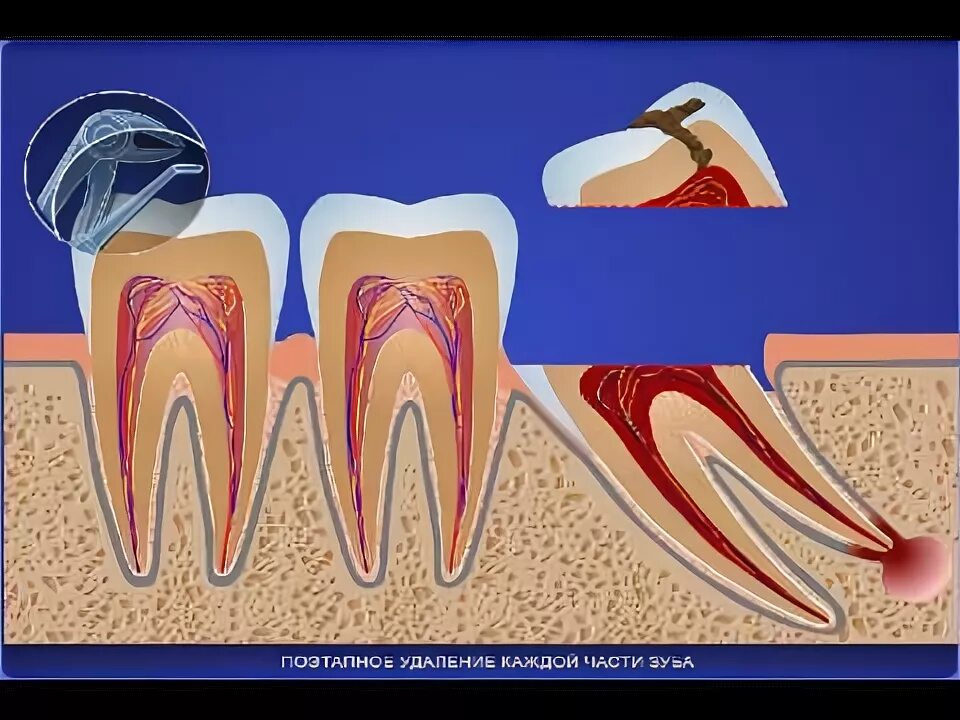 Сложное удаление зуба