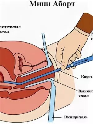 Вакуумное прерывание беременности после. Вакуумное выскабливание полости матки. Ревизия полости матки вакуумной аспирацией. Вакуумная аспирация чистка матки. Вакуумная аспирация аборт.