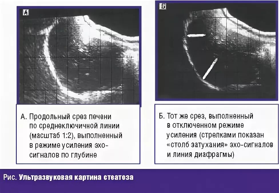 Диффузные изменения по типу стеатоза. Жировая инфильтрация печени узи. узи признаки стеатоза печени.