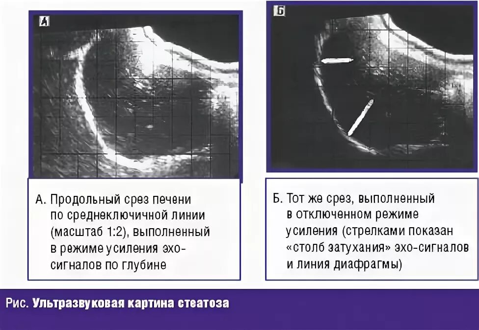 Жировая инфильтрация печени на УЗИ. УЗИ признаки стеатоза печени. Фиброзные изменения печени