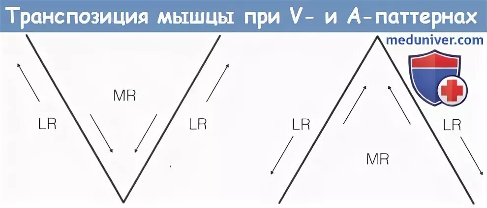Транспозиция внутренних