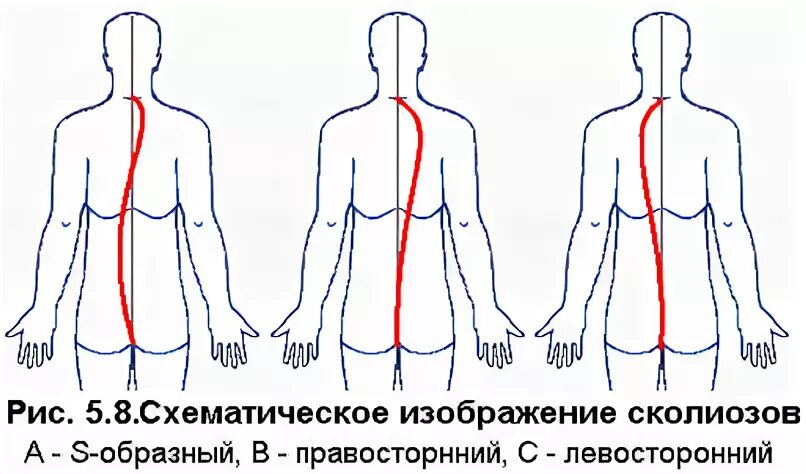 Левосторонний сколиоз 1