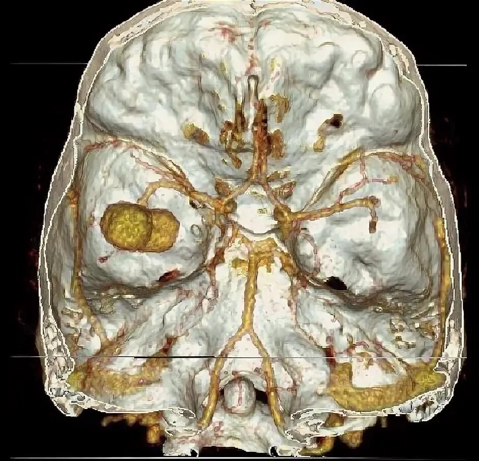 Кт (компьютерная томография) сосудов головного мозга. СКТ головного мозга. Кт реконструкция