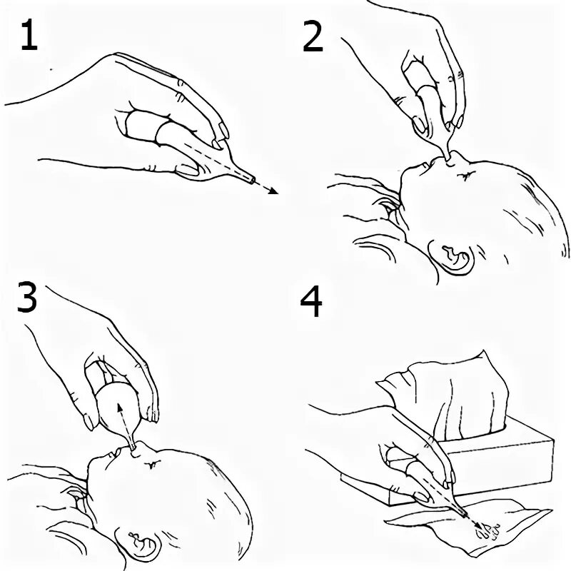 Закапывание капель детям алгоритм. Турунда в нос новорожденному правильно убираем сопли. Чистить нос турундочкой новорожденному. Как прочищать носик новорожденному ватным жгутиком. Жгутики для чистки носа новорожденного.