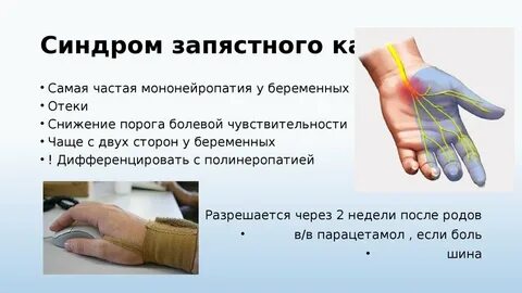 Запястный синдром