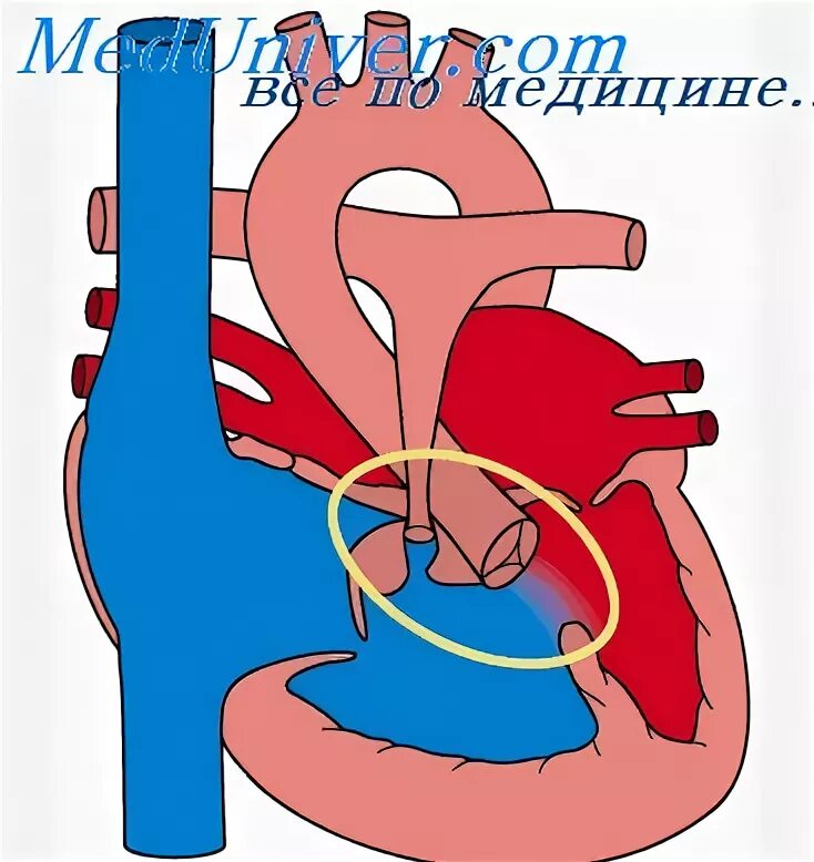 Дмжп 3 мм