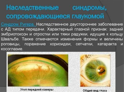 Глаукома мкб 10 у взрослых