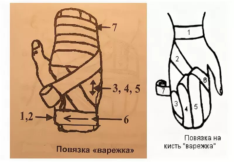 Техника наложения варежки. Наложение повязки варежка. Техника наложения повязки варежка. Перевязка варежка алгоритм. Бинтовая повязка варежка алгоритм.