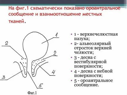 Цистоэктомия