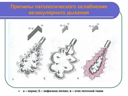 Аускультация при эмфиземе