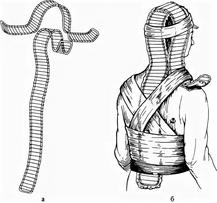 Шина при травме головы. Шина Крамера шейный отдел. Транспортная иммобилизация шейного отдела позвоночника. Иммобилизация шеи шиной Крамера. Иммобилизация шинами Крамера шейного отдела.