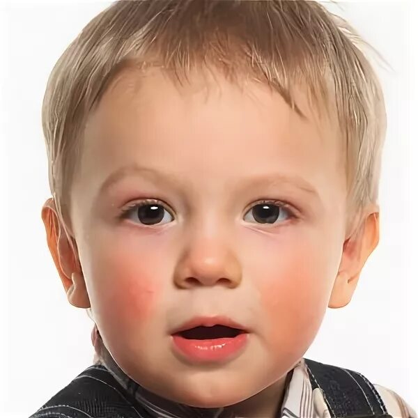 асимметричные глаза у детей.