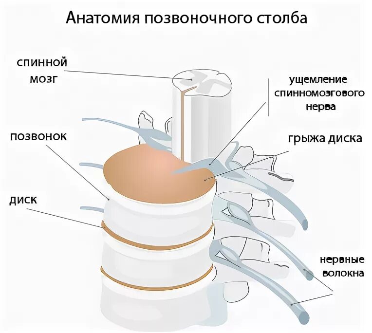 Экструзия дисков шейного отдела позвоночника. Грыжа позвоночника экструзия диска. Экструзия межпозвонковых дисков 4-5. Экструзия межпозвоночного диска поясничного отдела позвоночника. Дорзальная экструзия диска поясничного отдела что это.