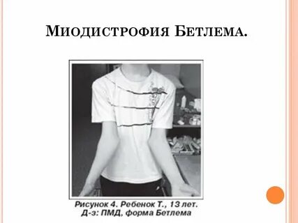 Врожденная мышечная дистрофия