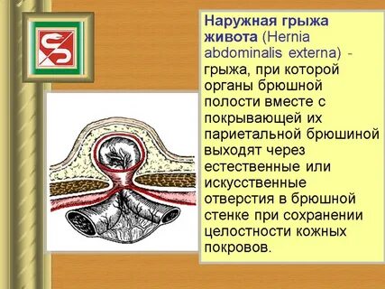 Стенки грыжи