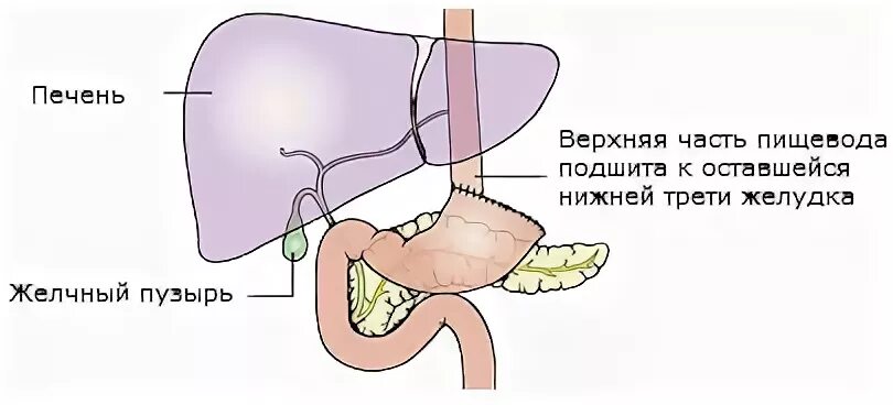 Рак желудка после удаления желудка