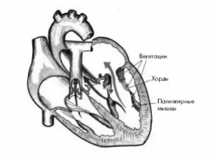 Атриовентрикулярный стеноз