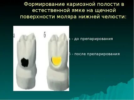 Наличие кариозных полостей