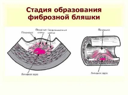 Формирование бляшки