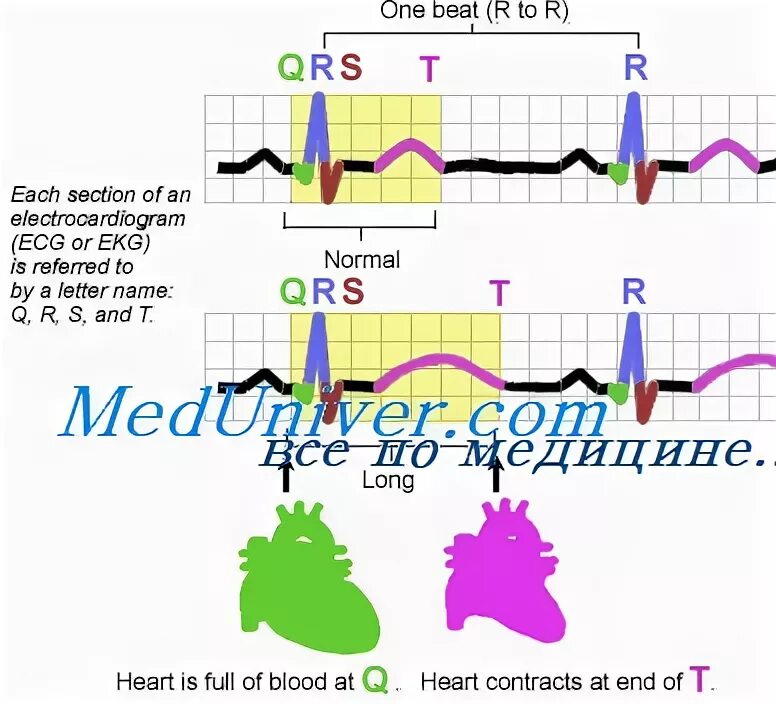 Удлинение интервала qt. Синдром удлиненного qt. Удлинение интервала QRS. Удлиненный интервал qt на ЭКГ что это такое.