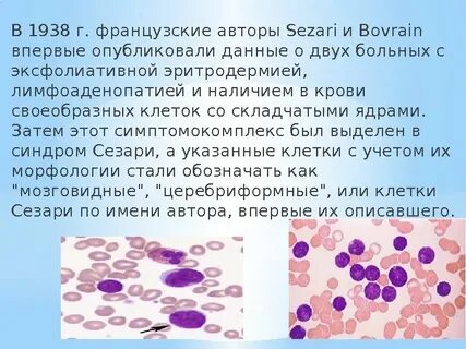 Тест синдром сезари ответы