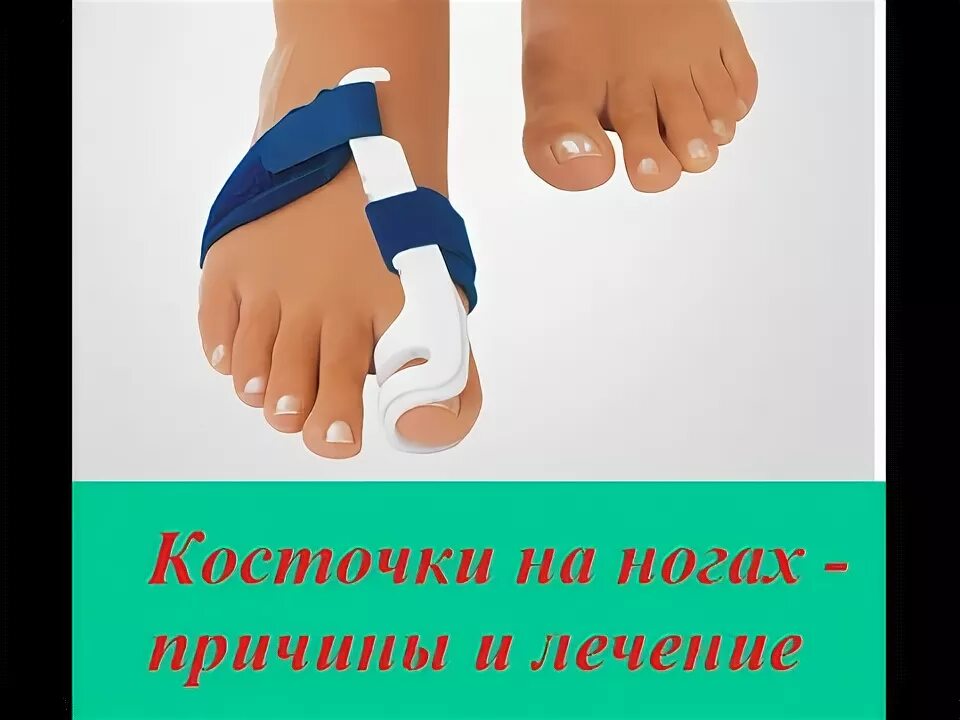 Рост кости на большом пальце ноги. Косточка на стопе причины. Малоинвазивная операция вальгусной деформации стопы. Косточка на стопе причины. Косточка на стопе причины.