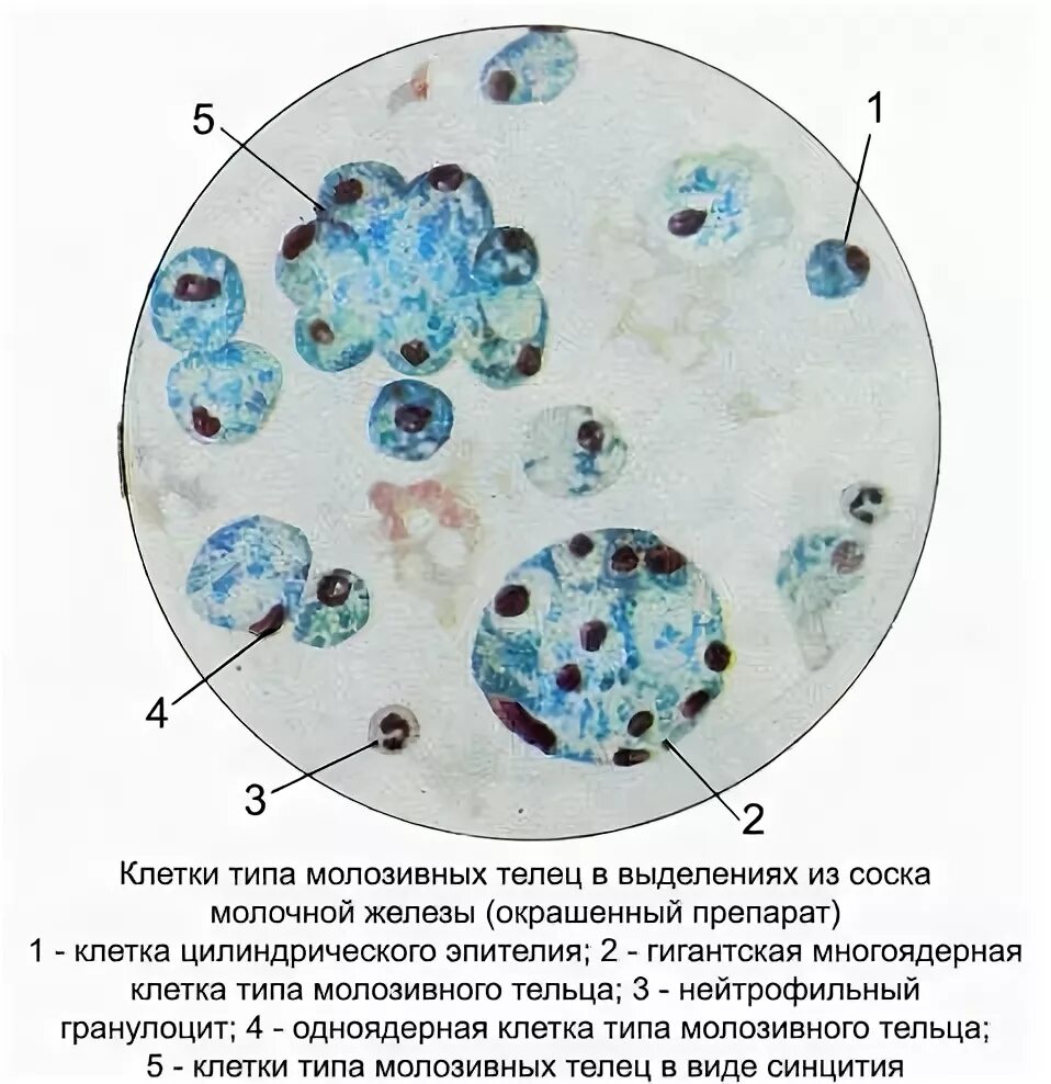 Макрофаги в молочной. Клетки макрофагального типа в цитологии молочной железы. Клетки молозивных Телец молочной железы что это. Микроскопия плевральной жидкости окрашенный препарат. Цитология опухоли молочной железы.