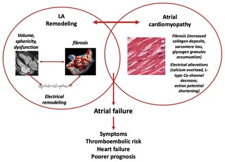 Diagnostics Free Full-Text Left Atrial Structural Remodelling in.