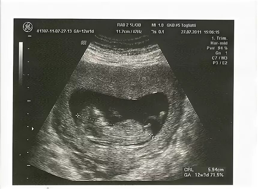 13 недель беременности пол ребенка на узи