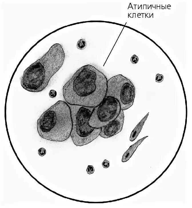 Мокрота на атипичные клетки