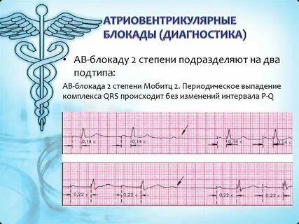 Диагноз блокада