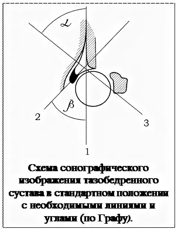 Норма углов тазобедренных. Узи тазобедренных суставов у новорожденных норма. углы при дисплазии тазобедренных суставов у грудничков норма. угол альфа тазобедренного сустава норма. узи тазобедренного сустава у новорожденных норма углов таблица.