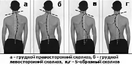 Сколиоз 1 степени берут