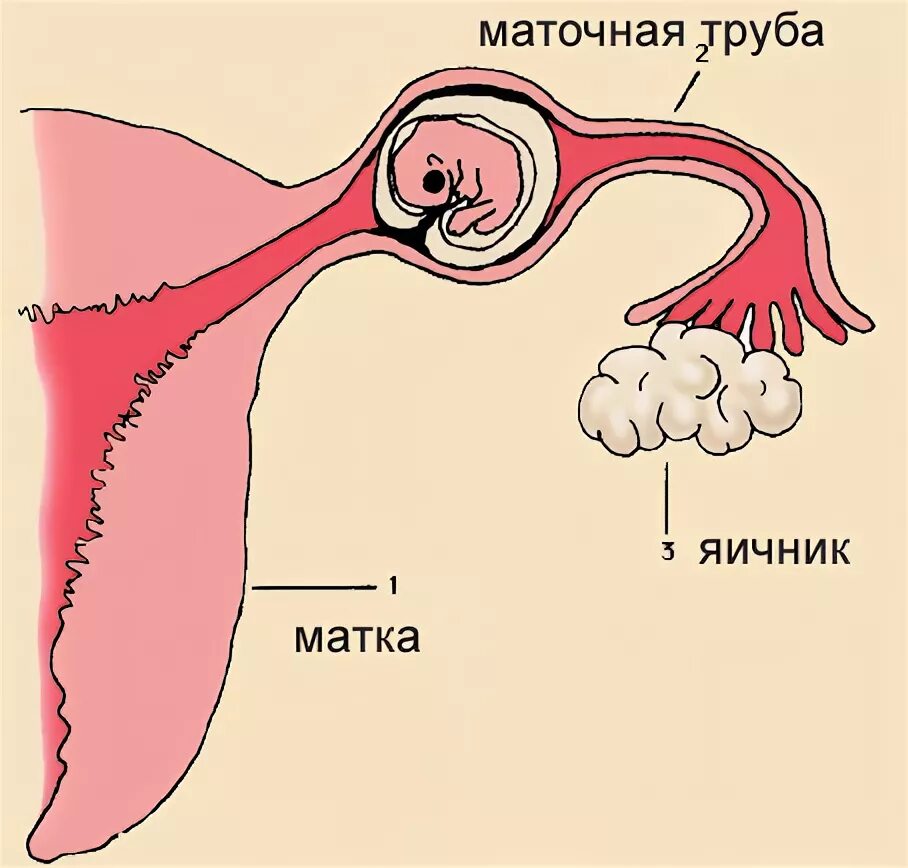 Содержимое в маточной трубе. Внематочная беременность трубный аборт. внематочная беременность в маточной трубе. ампулярная внематочная беременность. внематочная беременность схема.