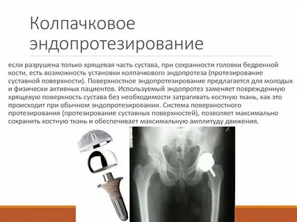 Эндопротезирование отзывы пациентов