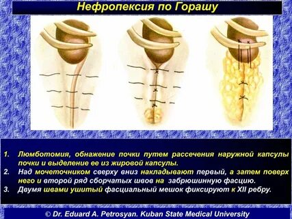 Нефропексия
