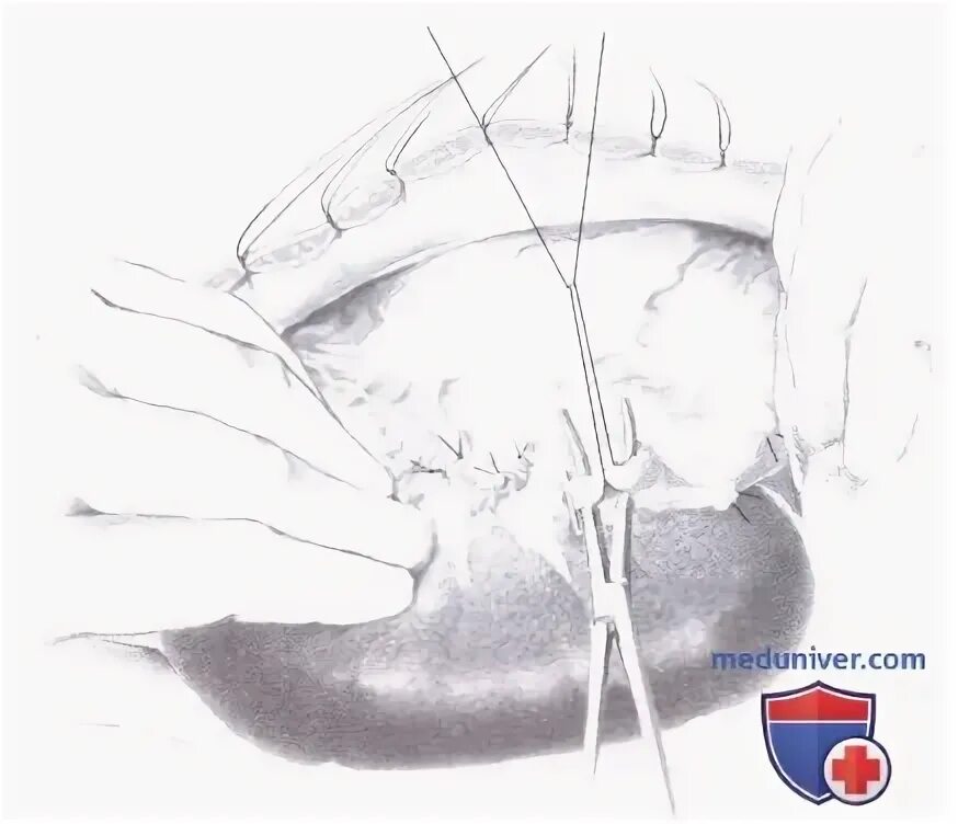 Переходящая операция. Переходящая операция
