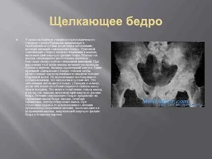Щелкает тазобедренный сустав при поднятии