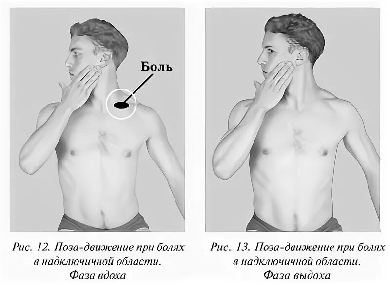 При вдохе больно под. Боль в надключичной области. Боль в надключичной области слева. Болит надключичная область. Надключичная ямка.