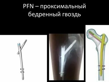Проксимальный бедренный