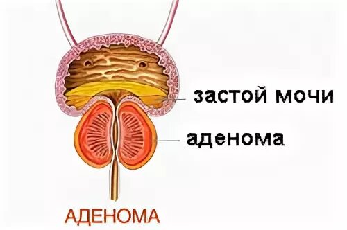 Удалить аденому предстательной железы