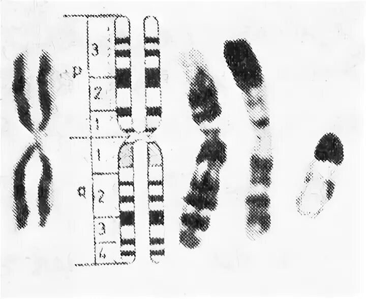 Изменение окраски хромосом. Кариотип дифференциальная окраска. Кариотип алкаптонурии. Дифференциальная окраска хромосом. Цитогенетический метод окрашивание хромосом.