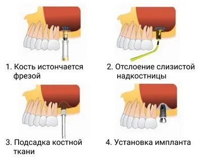 Синус в стоматологии это